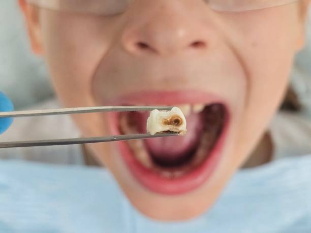 Best Emergency Broken Tooth Repair in Buttonwillow, CA